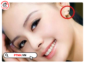 các vị trí nốt ruồi ở tai