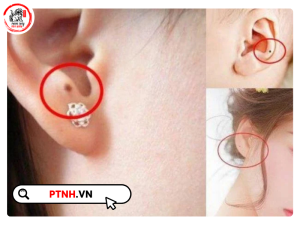 các vị trí nốt ruồi ở tai