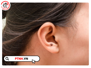các vị trí nốt ruồi ở tai