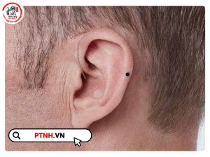 các vị trí nốt ruồi ở tai