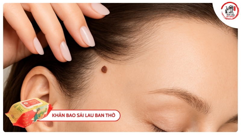 Giới Thiệu Về Nốt Ruồi Trong Tóc